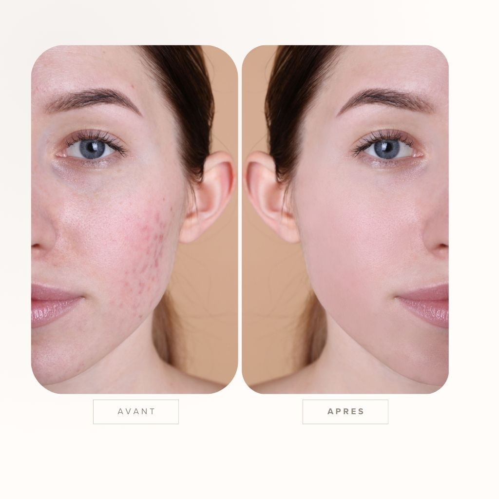 Purifiez, équilibrez, illuminez : votre routine anti-acné 100 % naturelle.